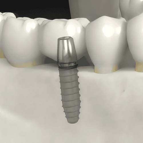All on 4 Dental Implants in Mexico - 4 Tips for Tourists